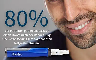 Narbenentfernung mit SkinPen Dortmund – glatteres Hautbild im Ruhrgebiet NRW